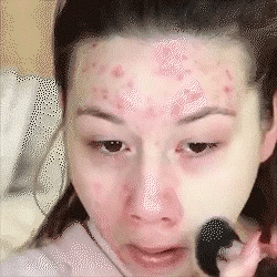 Woman applying makeup over acne on forehead.