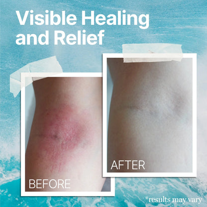 Healing Cream ~ Soothing relief for eczema and psoriasis in just days