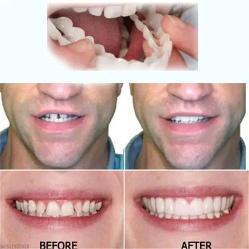 Snap-on veneers (Upper & Lower Set) ~ Instantly transform your smile with ease_