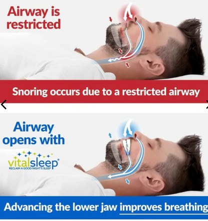 Anti-snoring mouthpiece  - Treat snoring and get restful sleep overnight