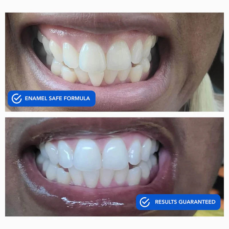 Diamond Dissolving Whitening Strips ~ Brighter, whiter smile in minutes.